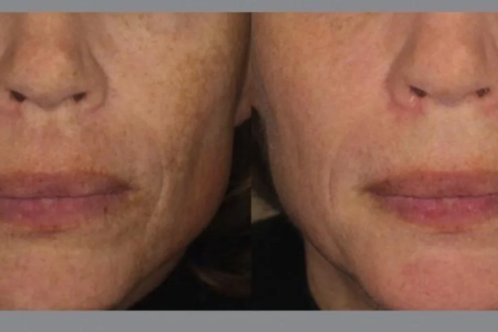 A woman 's face before and after using the dermapen.