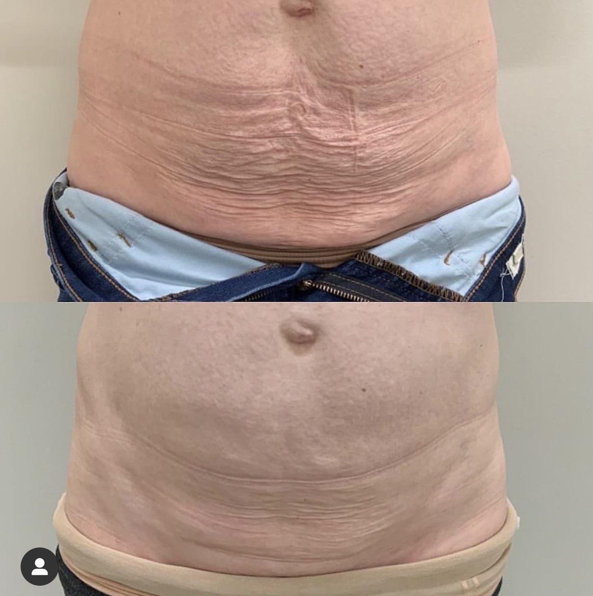 A before and after picture of the abdomen of a man.