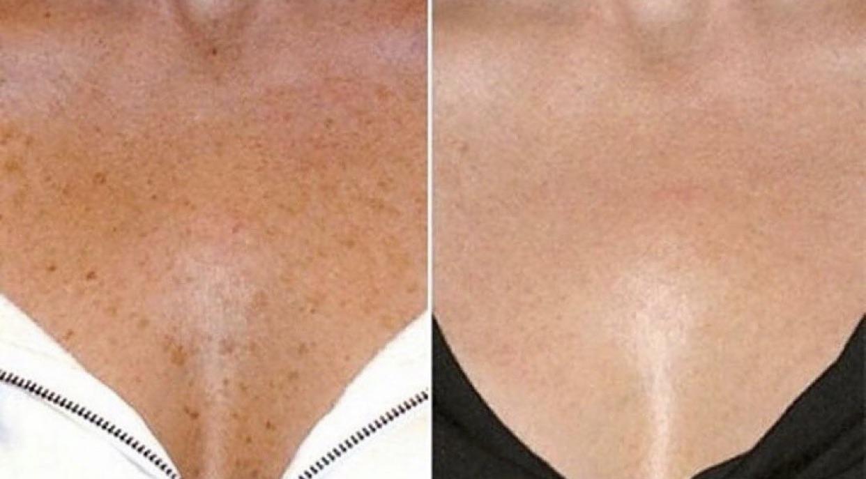 A woman 's chest and shoulders before and after using the laser.