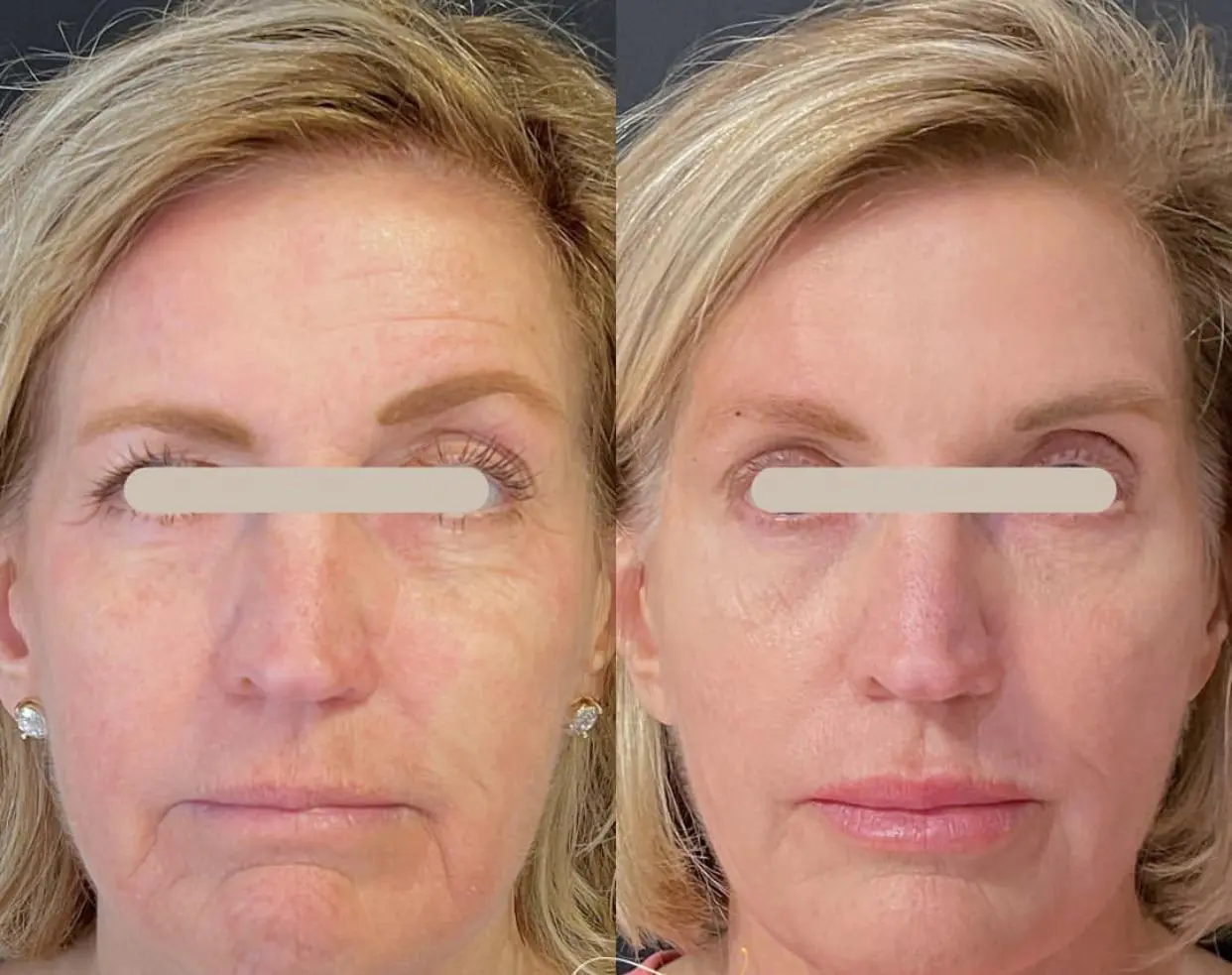 A woman with wrinkles on her face and under eye bags.