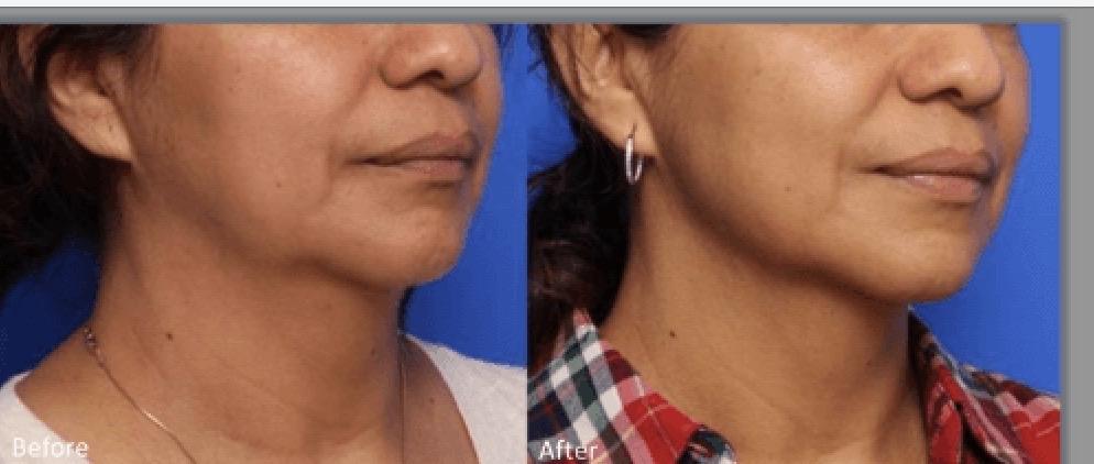 A woman 's face before and after undergoing a facelift.