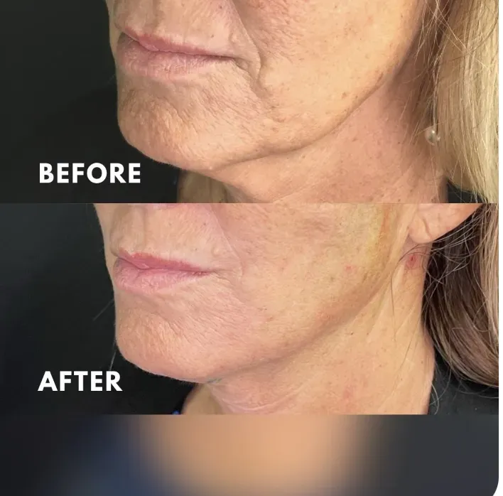 A woman 's face before and after using the botox method.