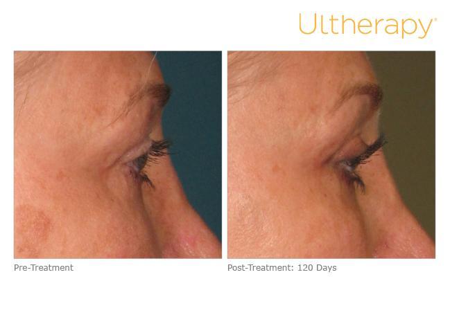 A woman 's eyes before and after using ultherapy